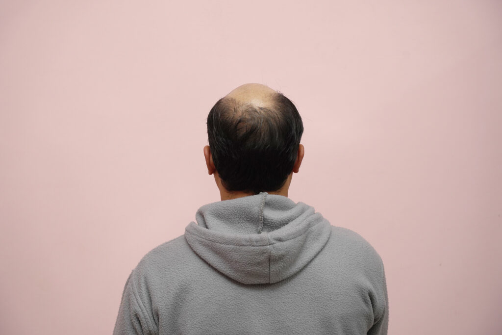 CAPELLI- CONSEGUENZE DELLO STRESS onhair.blog